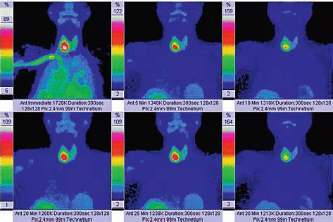 Technetium M Sestamibi Scintigraphy Showing Intense Tracer Uptake In