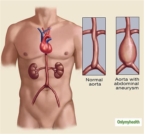 What Is Aneurysm? Here Are Its Symptoms, Causes, Diagnosis And ...