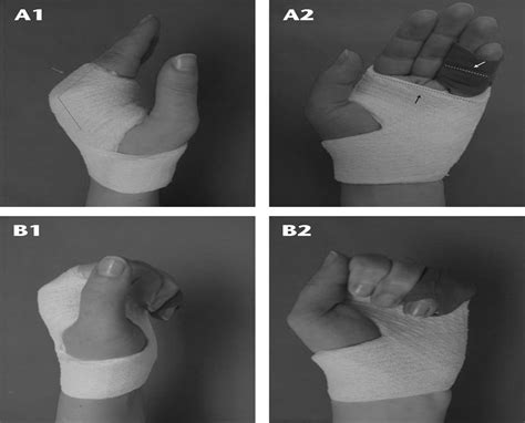 Early Functional Treatment of Proximal Phalanx Fractures in ...