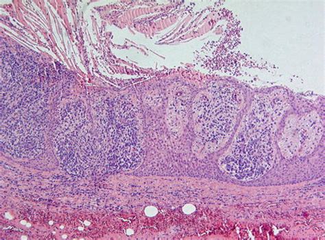 Radicular Cyst Vs Granuloma