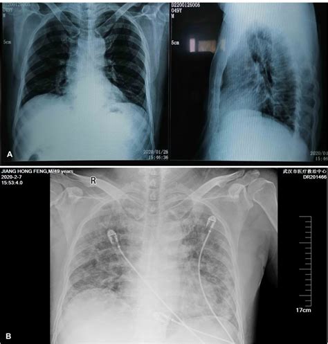 Figure Chest Radiographs Of Patient A Posteroanterior And Lateral