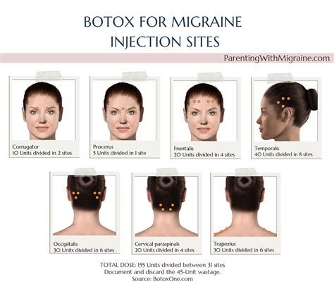 Botox For Migraine: Everything You Need To Know - Parenting With Migraine