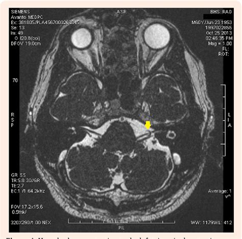 Trigeminal Neuralgia In A Patient With Vascular Loop Triggered By