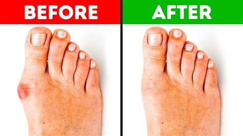 5 Effective Ways To Get Rid Of Bunions Youtube