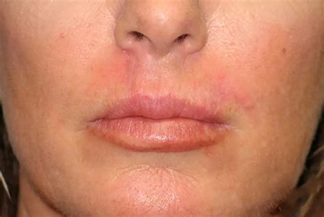 Full Lip Reconstruction Face Naked Studio