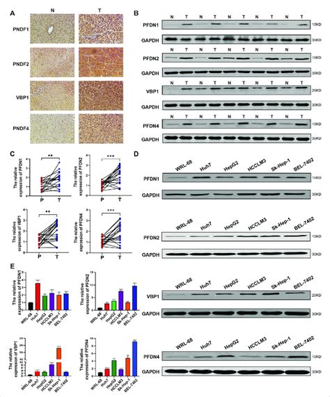 Expression Of Pfdn In Clinical Samples And Hcc Cell Lines A C