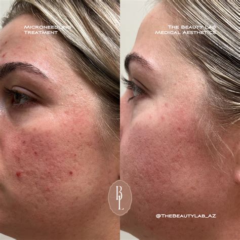 The Secret To Flawless Skin Microneedling S Transformative Power