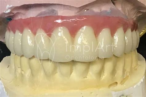 Protese Total Fixa Em Zirconia 49kb ImplArt