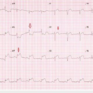 ECG ST elevation in inferior leads and anterior leads with ST... | Download Scientific Diagram