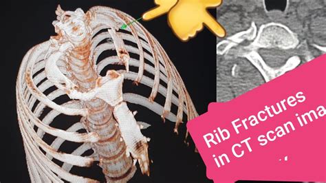 Fracture Fractured Rib On Ct Scan Youtube