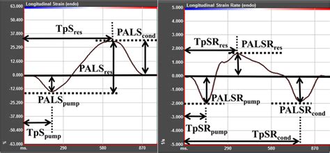 Schematic Diagram Of Measurements Of Peak Atrial Longitudinal Strain