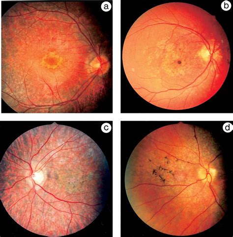 Cone Rod Dystrophy