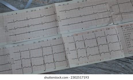 Electrocardiogram Ecg Ekg Chart Simple Test Stock Photo 2302517193 ...