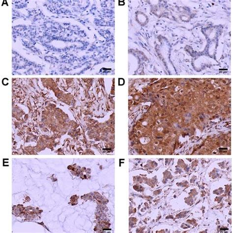 Transmembrane Protease Serine 4 TMPRSS4 Is Overexpressed In Breast