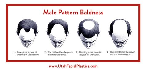 Male Pattern Baldness Treatment Slc Utah Facial Plastics