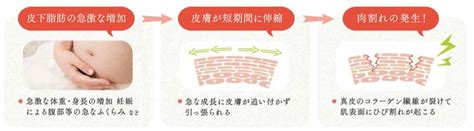 妊娠線ができる理由 ＆ 妊娠線を予防するにはどうすればいいの！？ 妊娠中のお悩み解決 麻布化粧品