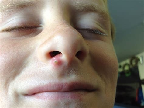 Potd 293 Giant Zit