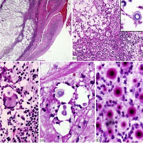 Laccase activity of Cryptococcus gattii strains with different level of ...