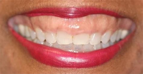 GUMMY SMILE CORECTION WITHOUT SURGERY -IZC,AND TADS&CROWN LENGTHENING