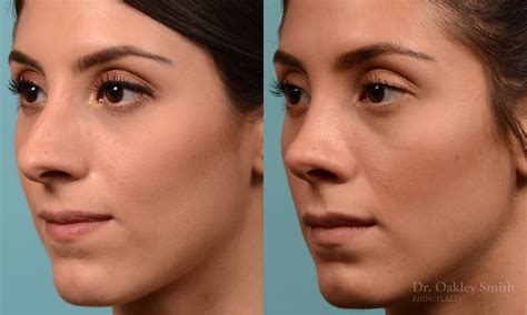 2295d Rhinoplasty Dr Oakley Smith Toronto Nose Job Toronto