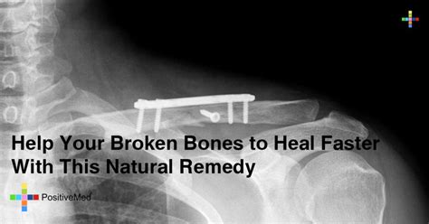 Help Your Broken Bones to Heal Faster With This Natural Remedy