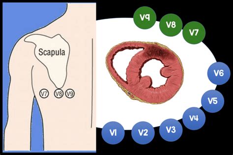 Five Ecg Patterns You Must Know Rebel Em Emergency Medicine Blog