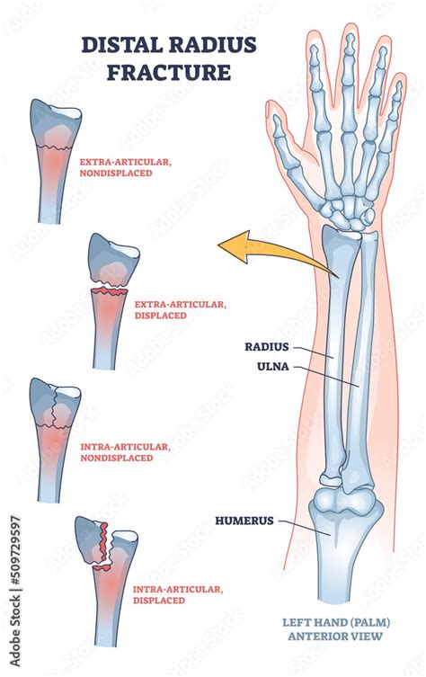 Distal Radius Fracture And Broken Arm Bone Types Anatomy Outline