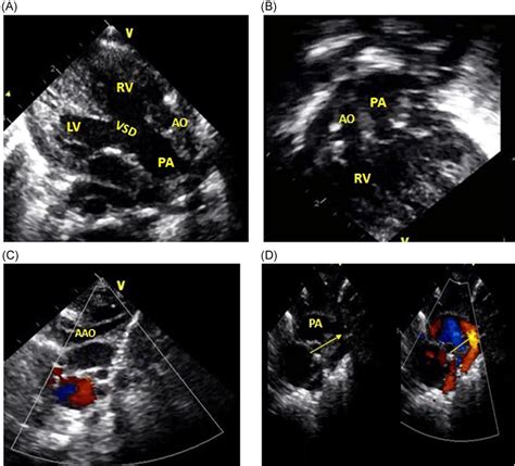 Preoperative echocardiography done for a neonate diagnosed as: D‐TGA ...