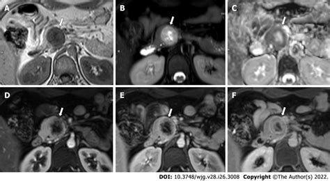 Magnetic Resonance Images Of A Year Old Woman With Multiple