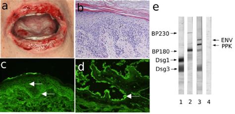 Paraneoplastic Pemphigus Histology