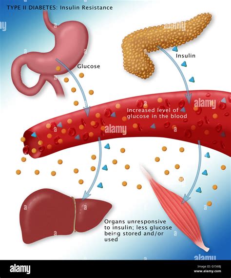 Illustration Of Insulin And Glucose Production In Type 2 Diabetes