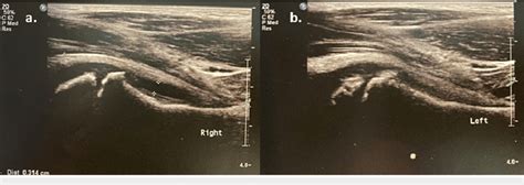 a) Right hip ultrasound demonstrating joint effusion (3.14 mm) (white... | Download Scientific ...