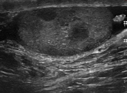 Testicular Seminoma Image Radiopaedia Org