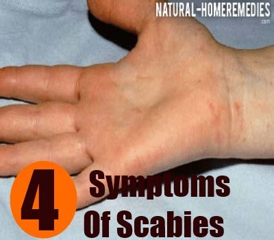 4 Most Common Scabies Symptoms - Signs And Symptoms Of Scabies ...