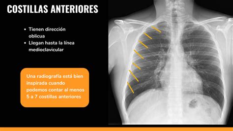 ¿cómo Interpretar Una Radiografía De Tórax Primera Parte Ondas Y