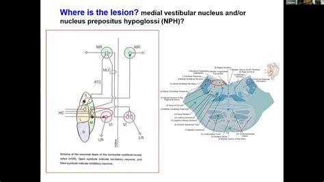 Angular Vestibulo Ocular Reflex VOR Impairment With Preserved