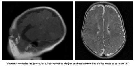 El Reci N Nacido Con Esclerosis Tuberosa Y Riesgo De Epilepsia