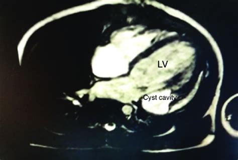 Magnetic Resonance Imaging Scan After Procedure Download Scientific