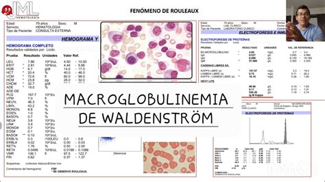 FENÓMENO DE ROULEAUX EN MACROGLOBULINEMIA DE WALDENSTRÖM YouTube