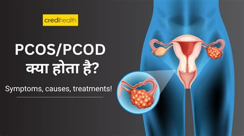 PCOS PCOD कय हत ह Symptoms causes treatments Tips for