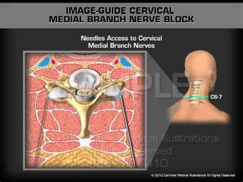 Medial Nerve Block Lumbar