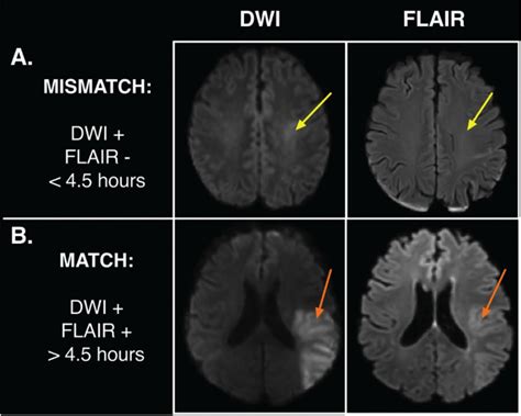 Figure 4 The DWI T2 FLAIR Mismatch Approach To Stroke NCBI