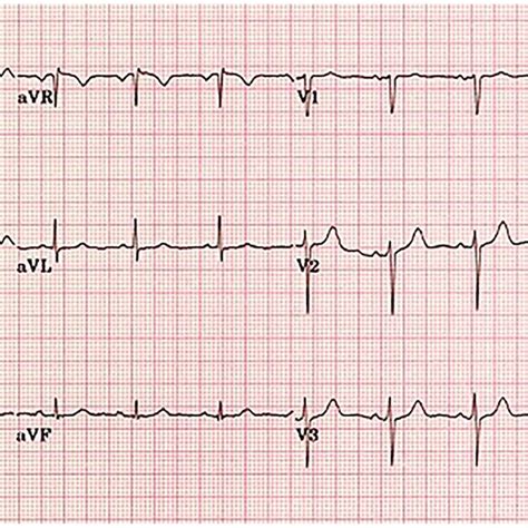 This Figure Illustrates Cardiac Action Potential In The Normal Black