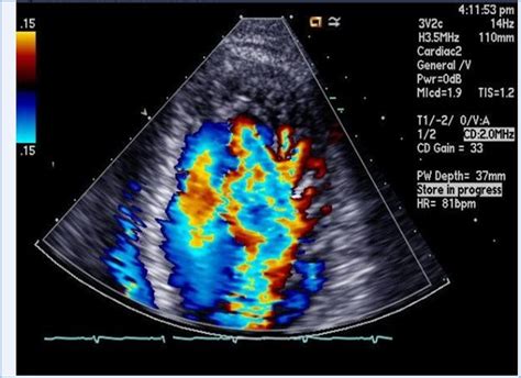 Figure Evidence Of Direct Blood Flow From The Ventricular Cavity