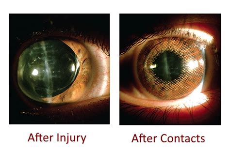 Eye Injuries Help Is On The Way Bright Eye Care And Vision Development