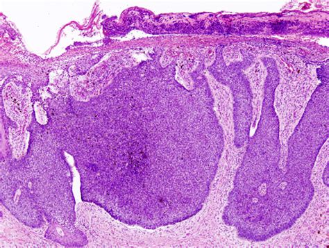 Basal Cell Carcinoma Pathology Student