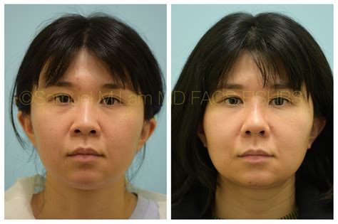 Nose Jobs Before And After Asian