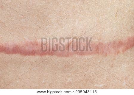 Close Cyanotic Keloid Image & Photo (Free Trial) | Bigstock