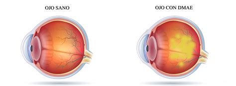 Degeneraci N Macular O Dmae Tratamiento Y S Ntomas Mart Nez De Carneros