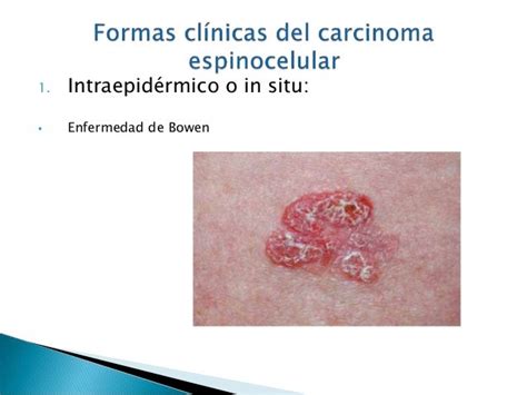 Carcinoma Basocelular Y Espinocelular